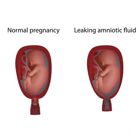 leaking early pregnancy|Leaking Amniotic Fluid During Pregnancy